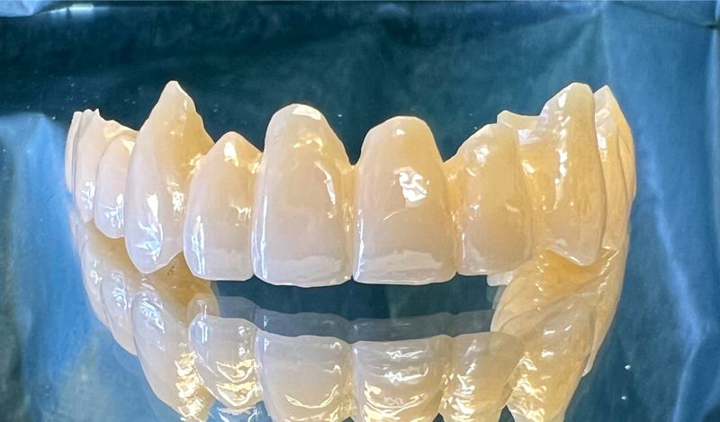 Restaurations en zircone pour toute la bouche