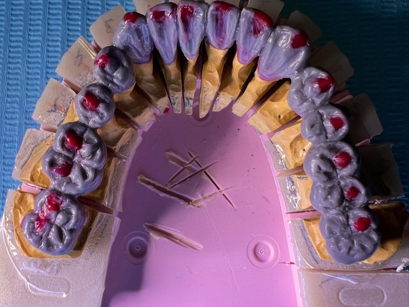 Wax-up des gesamten Zahnbogens auf einem Sägeschnittmodell