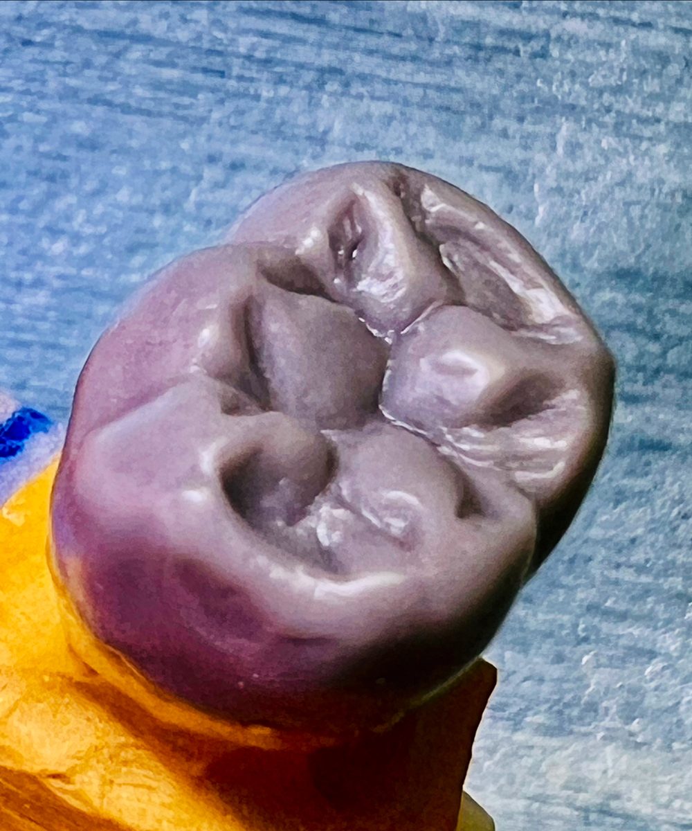 一本の歯の模型の上につくった、紫色のワックスの奥歯