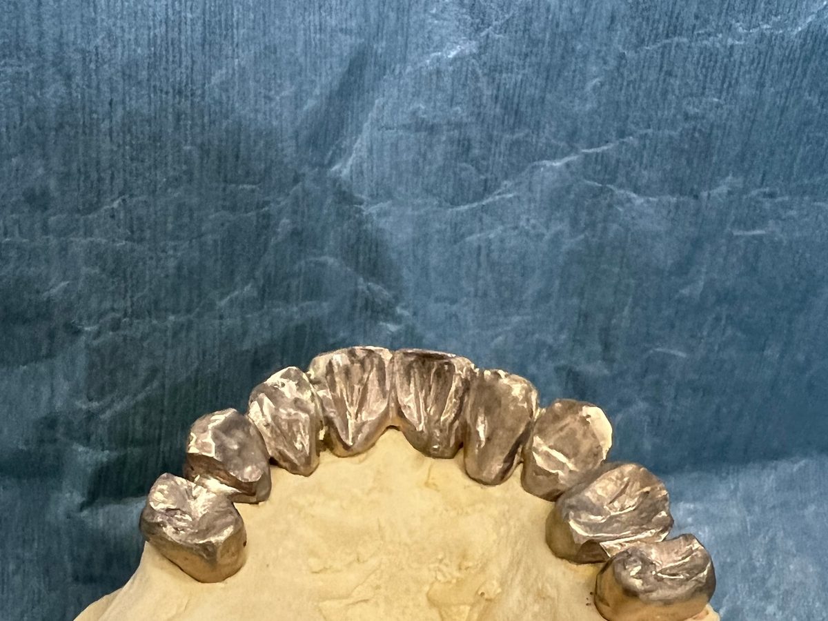 模型の上の歯に並んだ、金属のメタルオーバーレイ