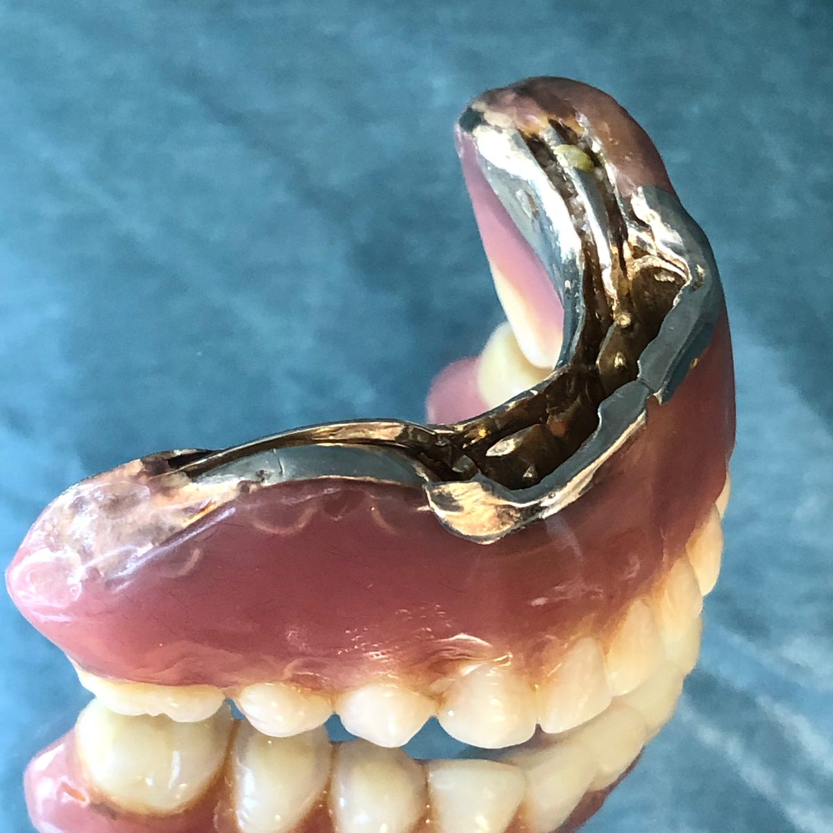金属のフレームが入った上の入れ歯を、横から見たところ