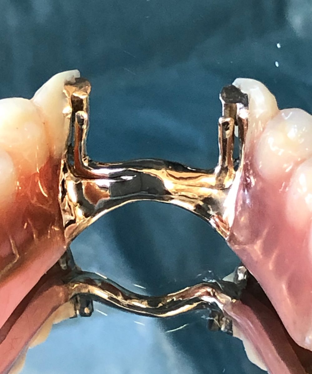 アタッチメントを組み込んだ、部分入れ歯の金属のフレーム