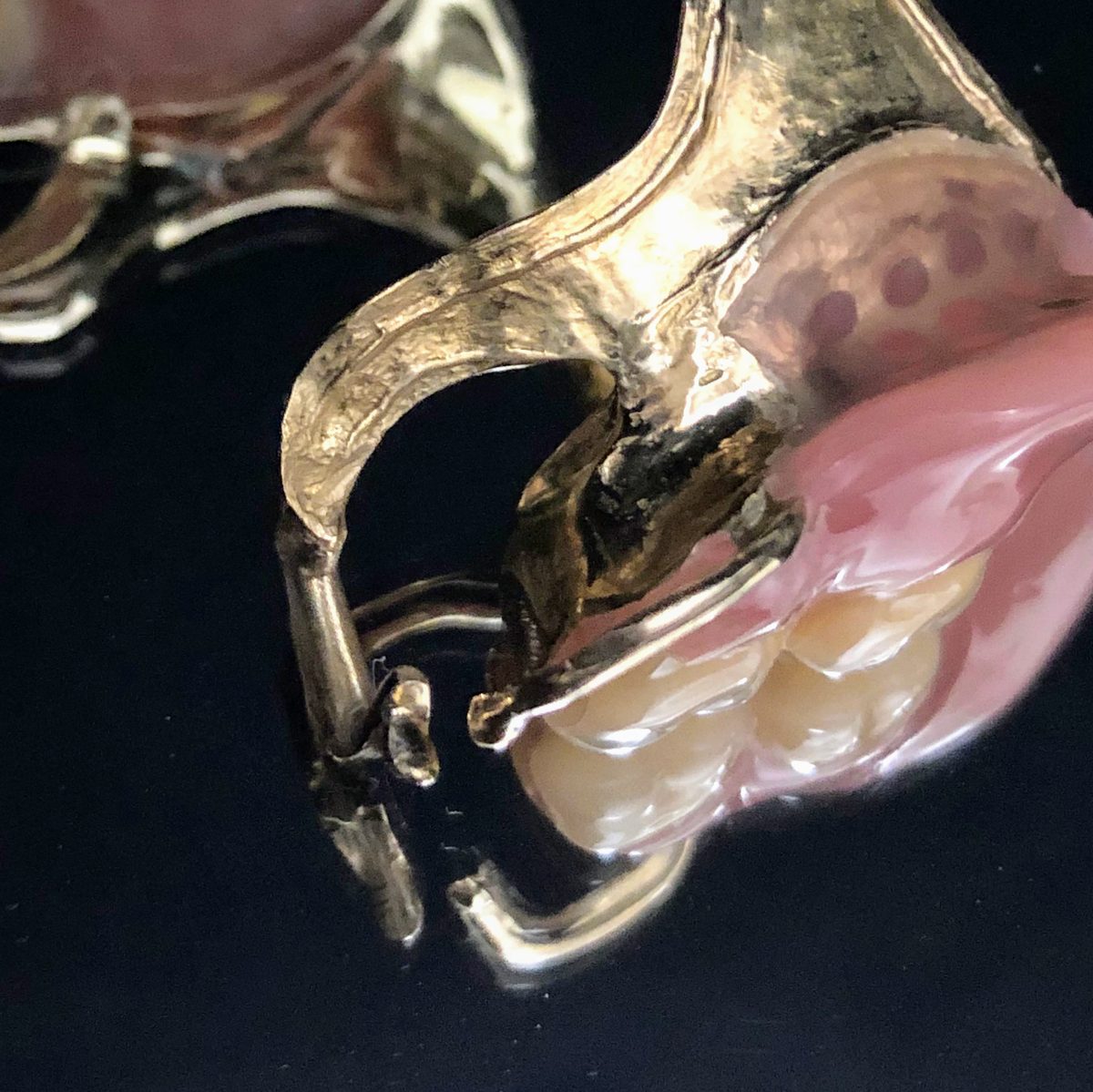 金色の金属のフレームの入れ歯(拡大)