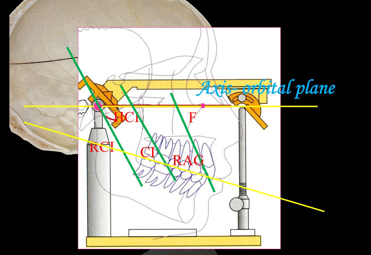 頭の骨格の図に咬合器の図を重ね、アキシス・オルビタール平面(Axis-orbital plane)や角度の線を書き入れた図