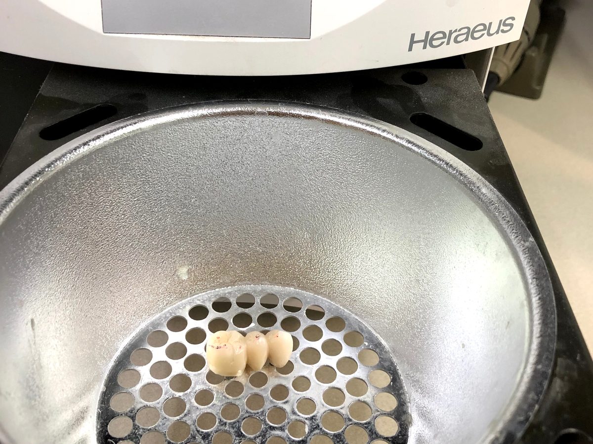 重合器の中に置いた、奥歯の仮歯