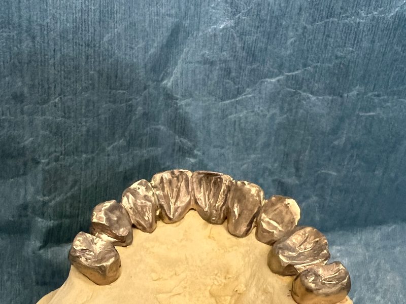 Goldfarbene Metall-Overlays auf dem Zahnbogen eines Modells