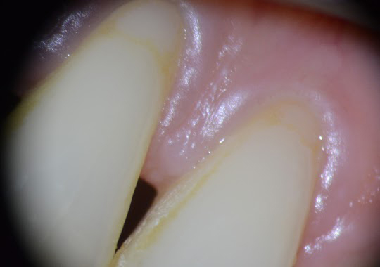Trattamento con il microscopio
