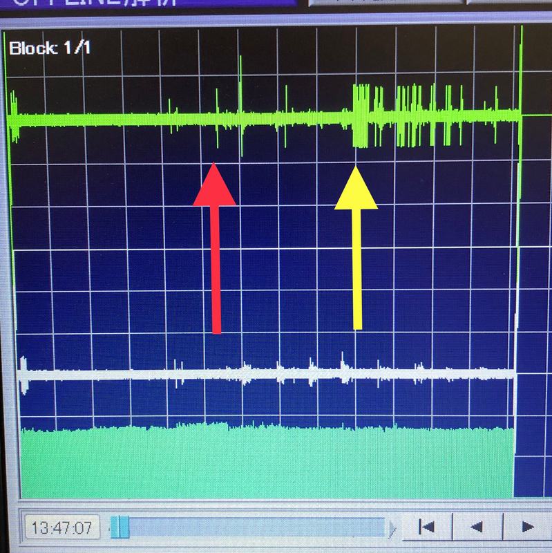 Aufzeichnungsbildschirm der Elektromyographie
