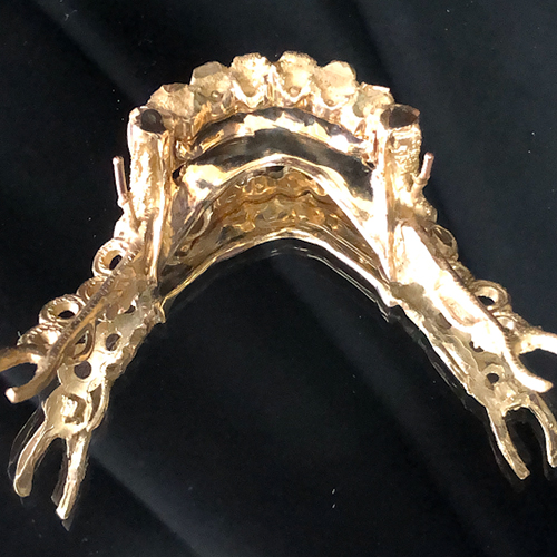 Un cas associant implants et prothèse amovible
