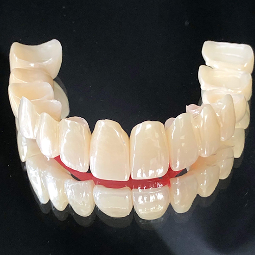 Orthodontie sans extraction pour des troubles temporo-mandibulaires et restaurations en céramique zircone